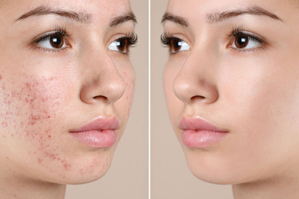 Teenage girl before and after acne treatment on beige background