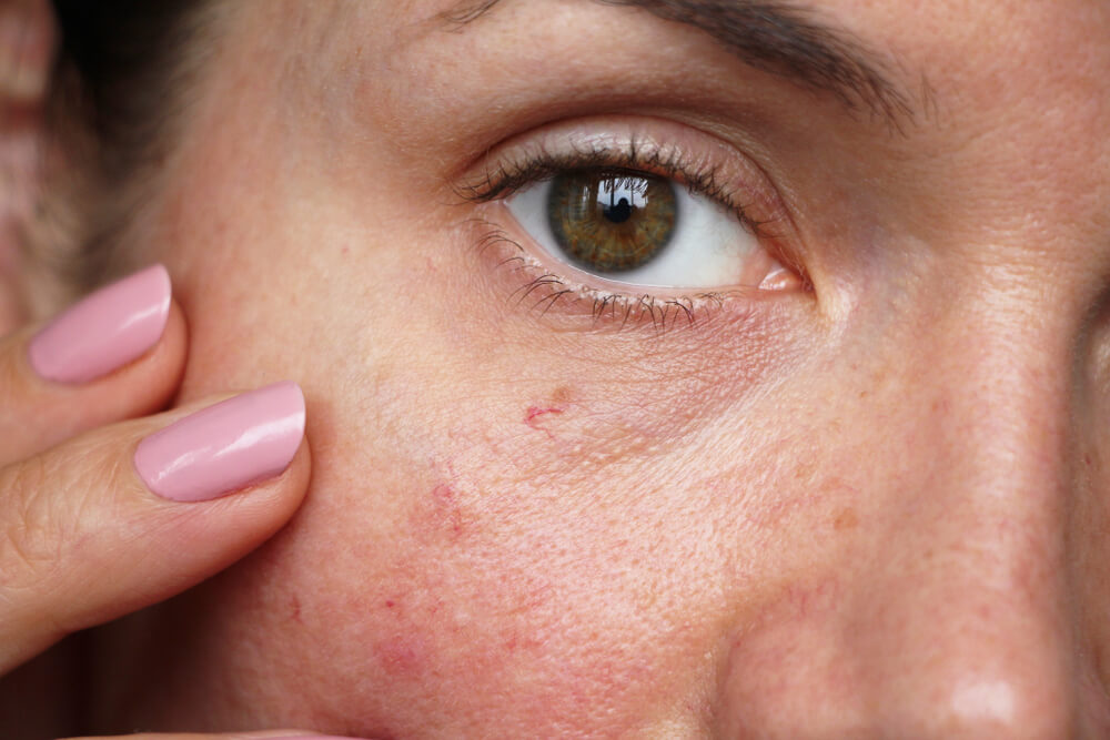 capillaries on the skin of the face